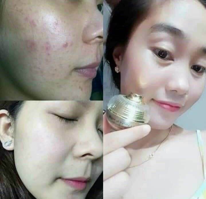[HCM]combo 2 hộp kem chuyên mụn 260000