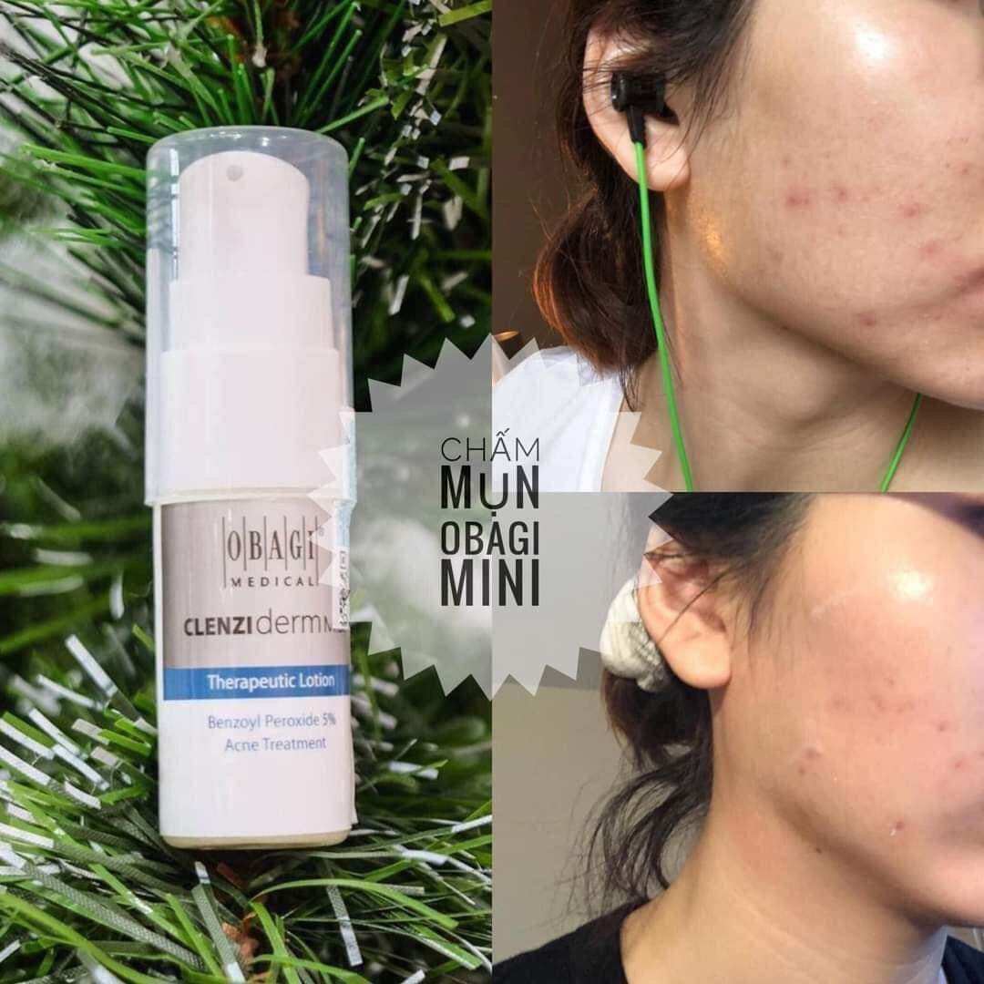 [HÀNG CTY] LOTION CHẤM MỤN MINI BPO 5% 10ML