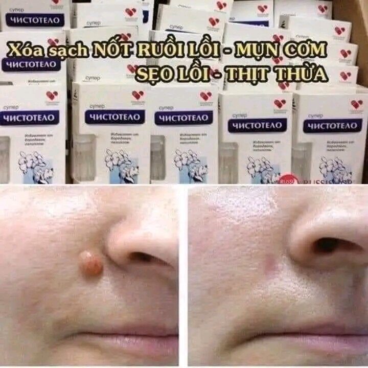Gel tẩy nốt ruồi