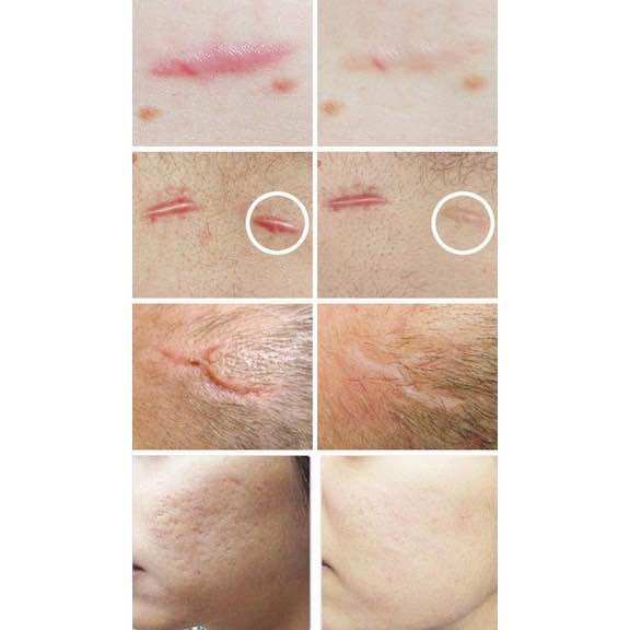 Gel mờ sẹo strataderm 5gr Thụy Sỹ