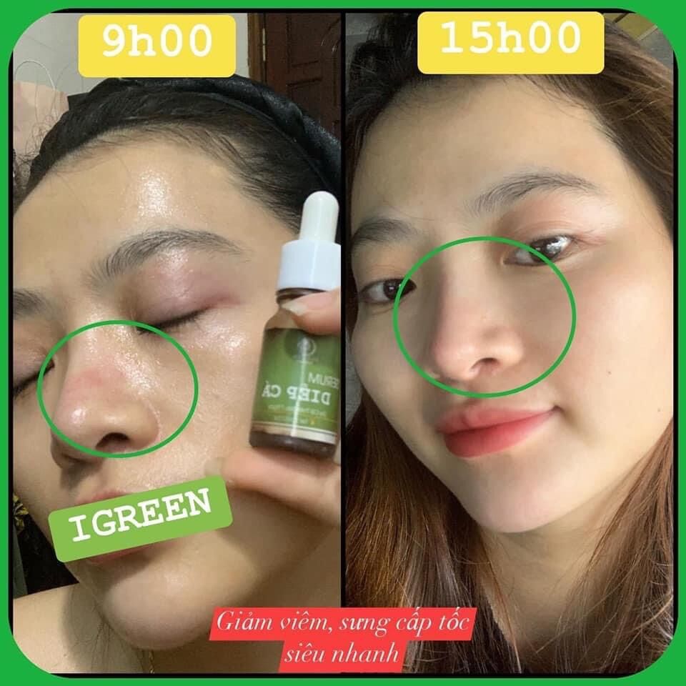 SERUM DIẾP CÁ GIẢM MỤN, THÂM, SE KHÍT LỖ CHÂN LÔNG - IGREEN