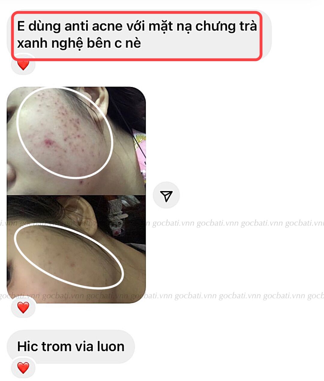 ANTI ACNE SERUM GBT