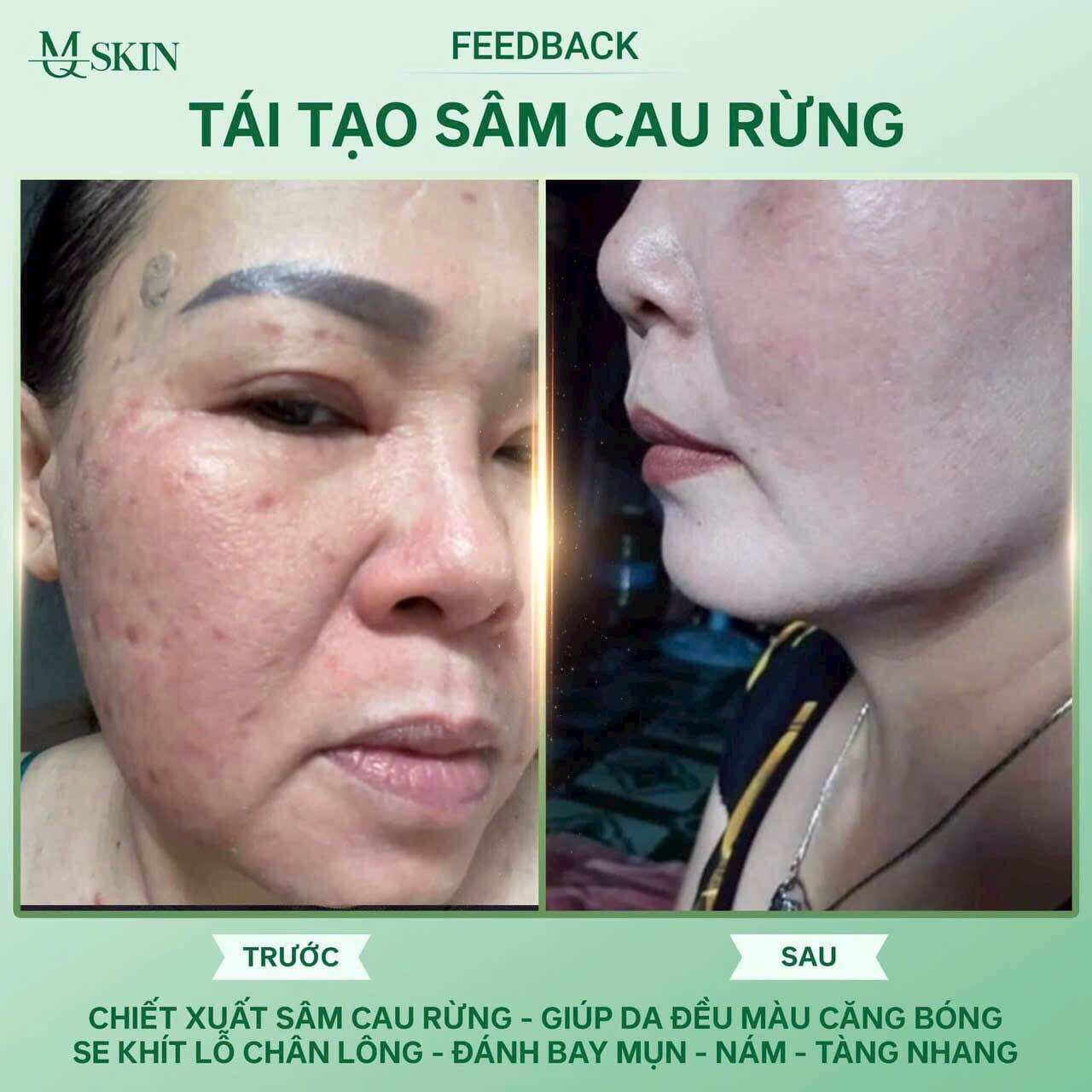 Combo Tái tạo sâm cau rừng( liệu trình 3 món)