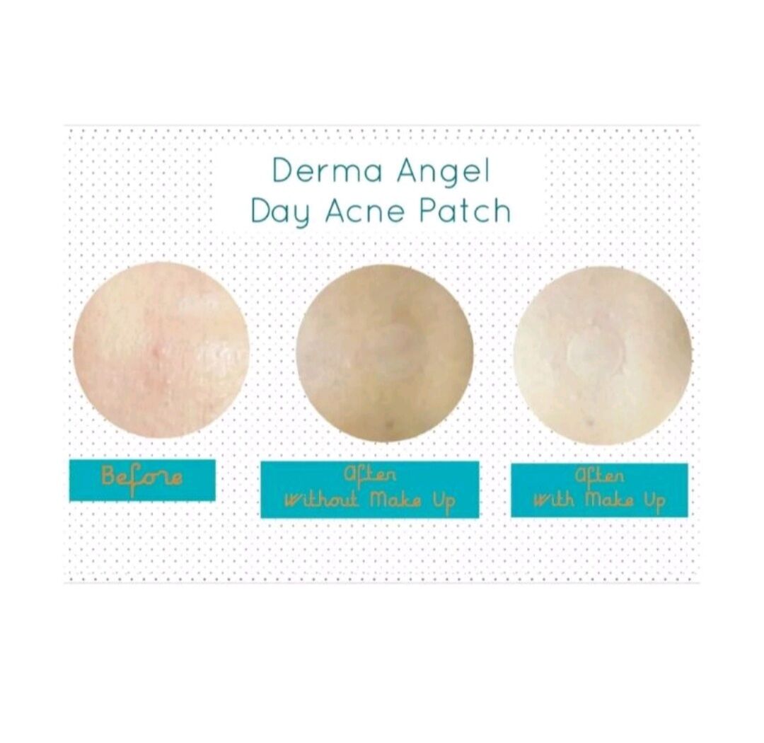 Miếng dán mụn ban ngày Derma Angel (12 miếng/hộp)