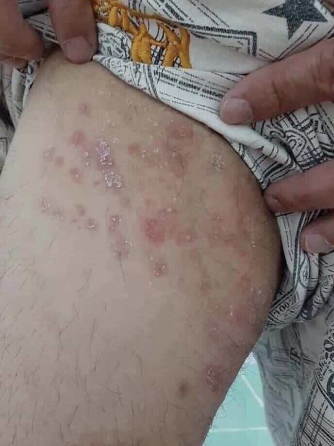 Thảo dược quý BÔi Hắc lào, lác đồng tiền, nấm bẹn
