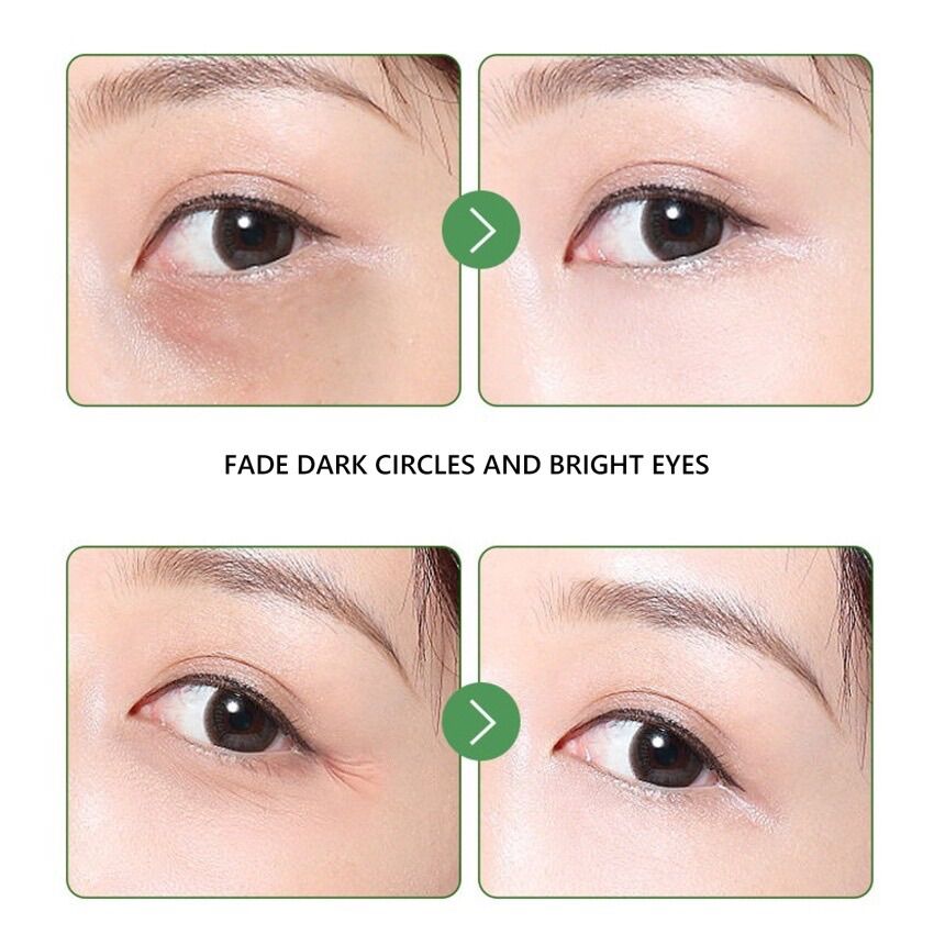 Kem mụn thịt Yaqinuo, kem bơ giảm mụn thịt