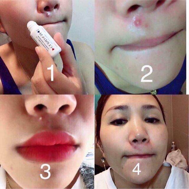 Chấm Mụn Clinda-M Thái Lan
