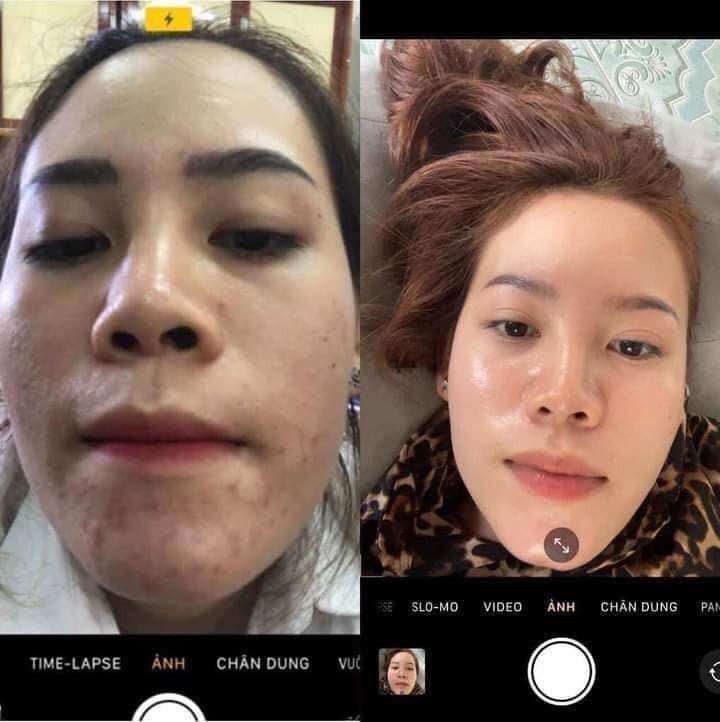 Thuốc bắc tái tạo da mụn