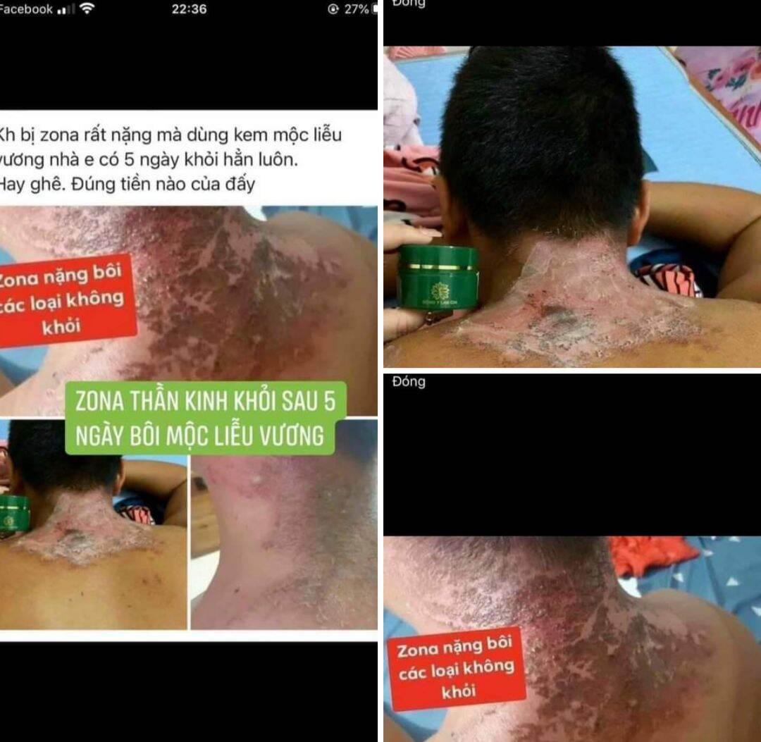 KEM BÔI DA MỘC LIỄU VƯƠNG (KHẮC TINH CÁC BỆNH VỀ DA )