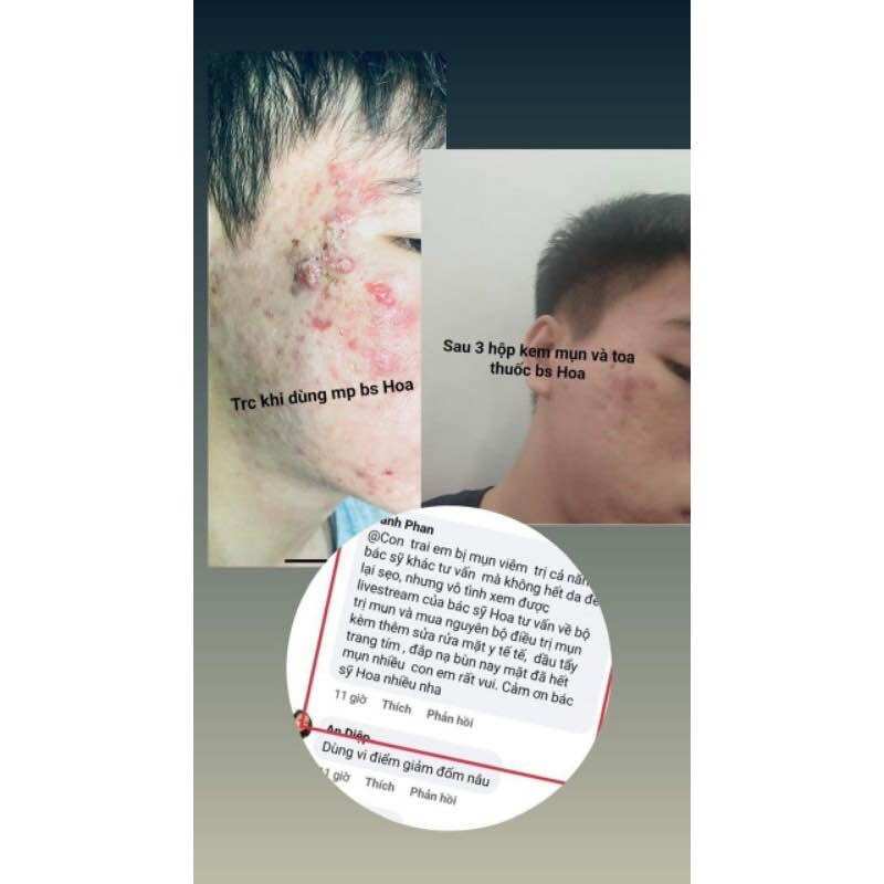 KEM MỤN ANGEL chính hãng 15g