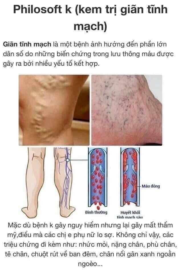 kem bôi giãn tĩnh mạch philosoft 25g thái lan