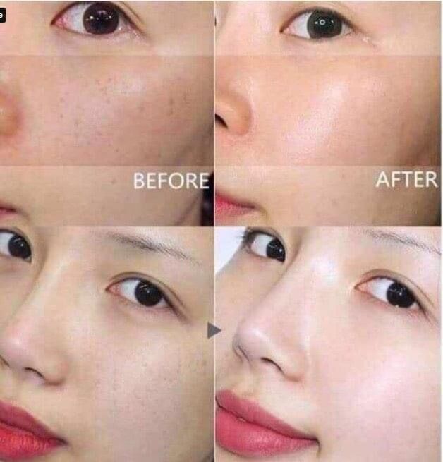 Kem trị nám Dongsung Rannce 70g 동성랑스 크림 (피부 미백)