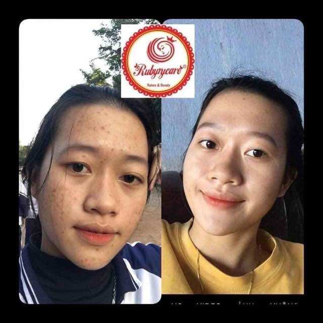 Thuốc trị mụn RubyCare