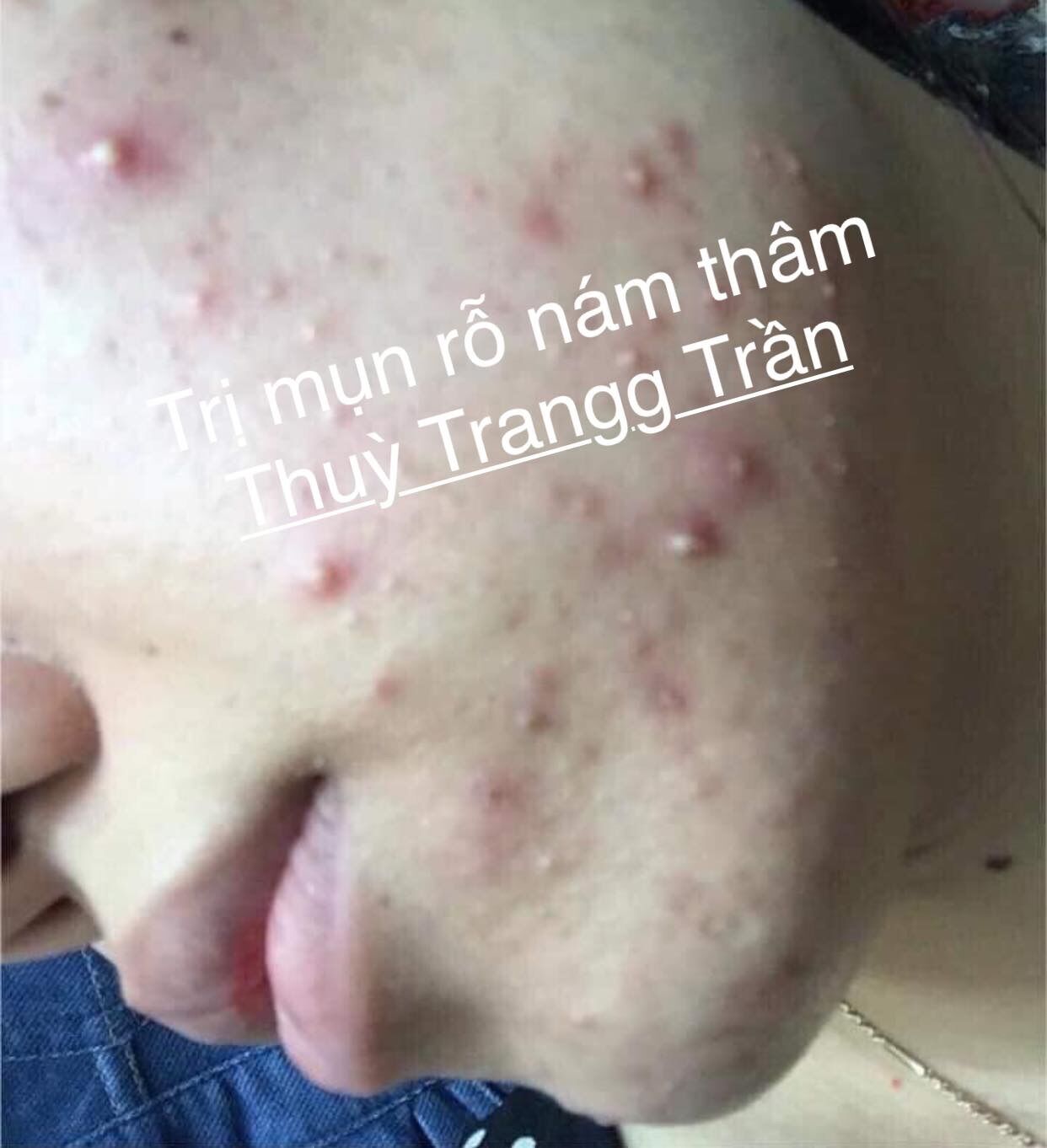 combo sạch mụn thâm rỗ 8 tuần(LO 100ML+ BOT KIEM DAU)