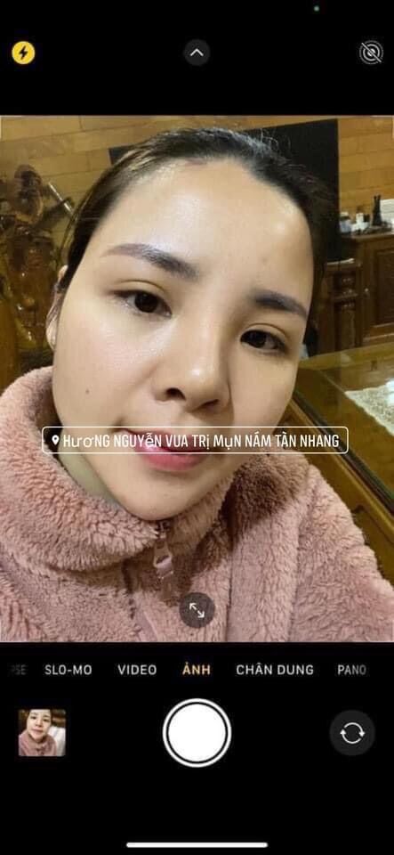 Serum Mộc Beauty Ngăn Ngừa Mụn Thâm