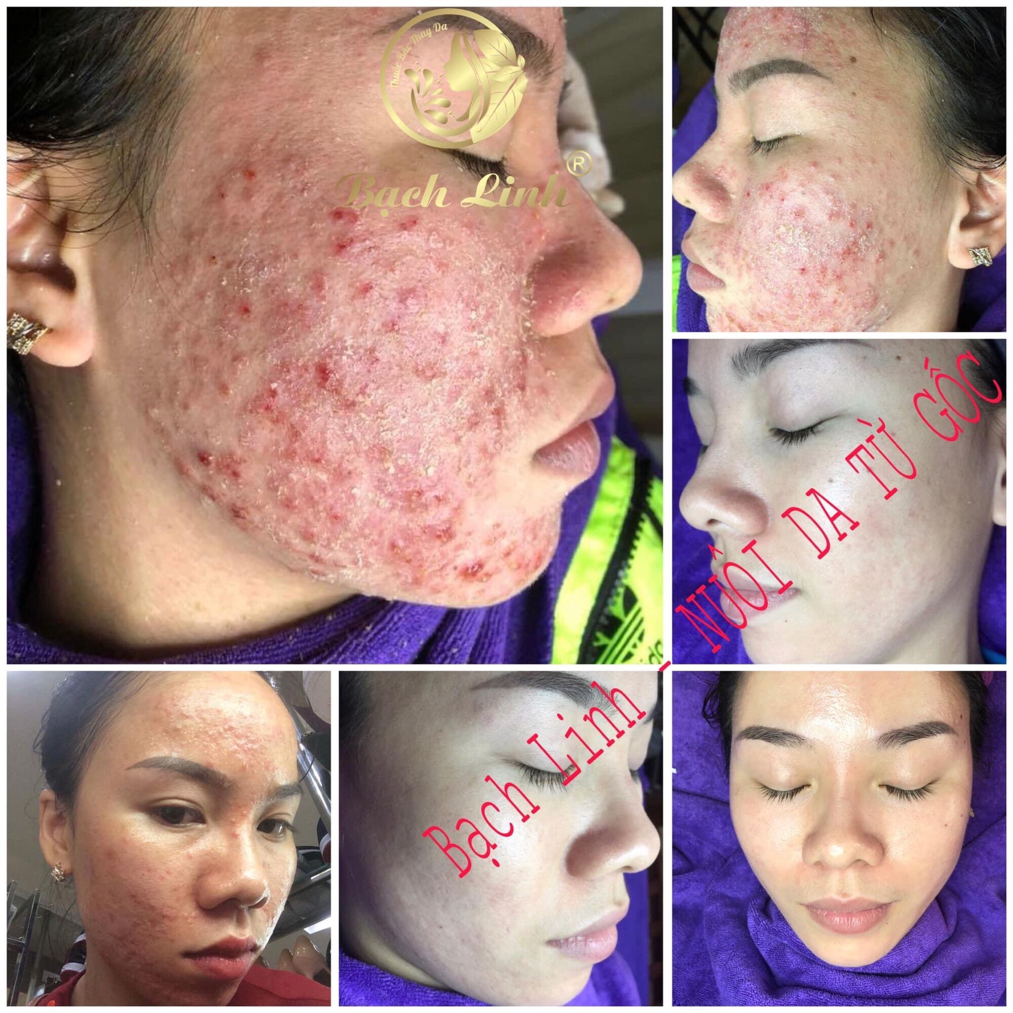 Combo cho da mụn Bách y sâm - bạch linh (tặng 1 hộp ngâm chân Bách thọ khang 195k)