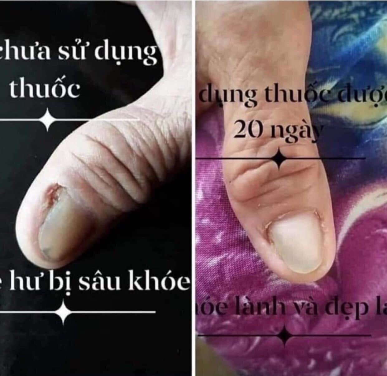 Dung Dịch Nấm Móng