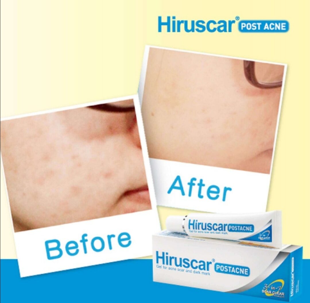 GEL LÀM MỜ SẸO MỤN VÀ MỤN THÂM HIRUSCAR POST ACNE