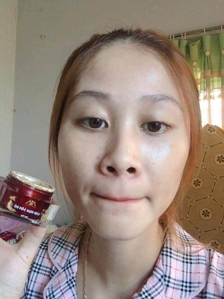 Cao sâm mụn chuyên mụn và thần thánh mụn