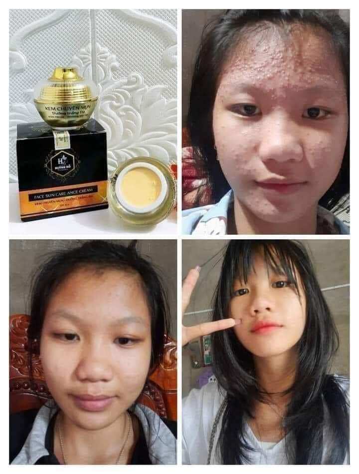 kem chuyên mụn huỳnh đỗ