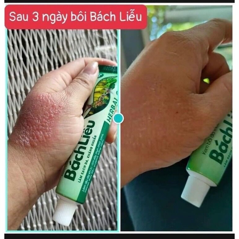 Kem bôi da thảo dược bách liễu