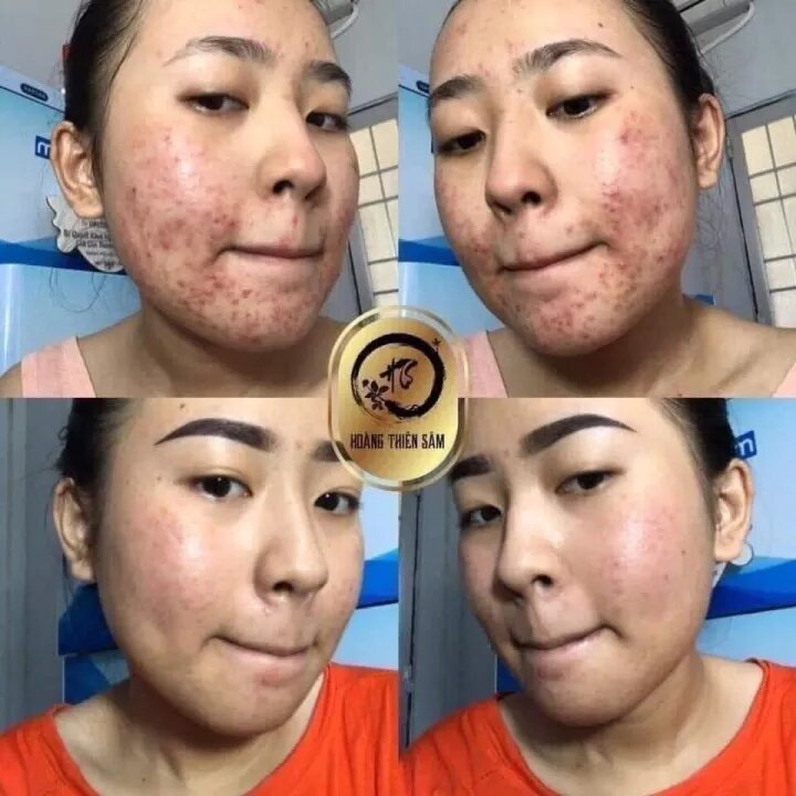 combo tinh chất Hoàng Thiên Sâm