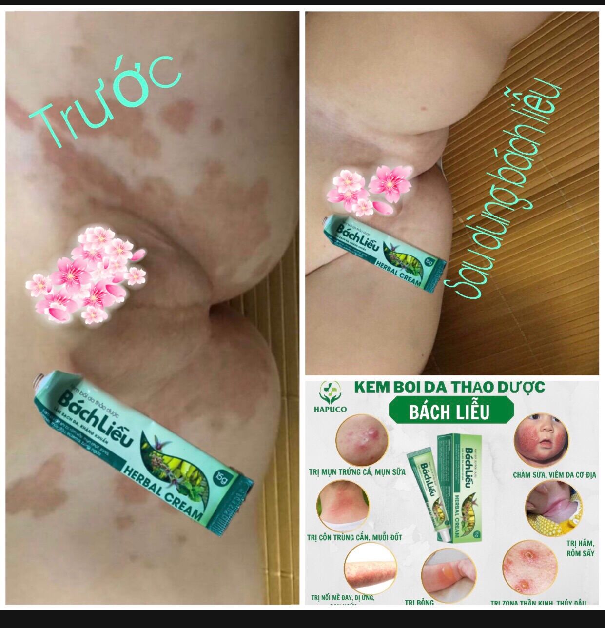 Kem bôi da thảo dược Bách Liễu 15gr