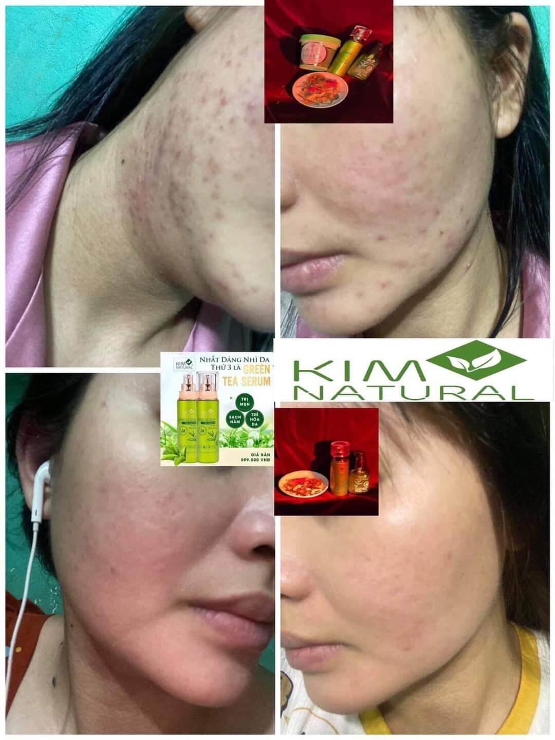 COMBO SERUM TRÀ XANH VIP TÁI TẠO LÀN DA