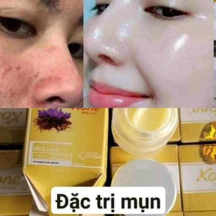 Kem kone hộp vàng thái lan cho da mụn