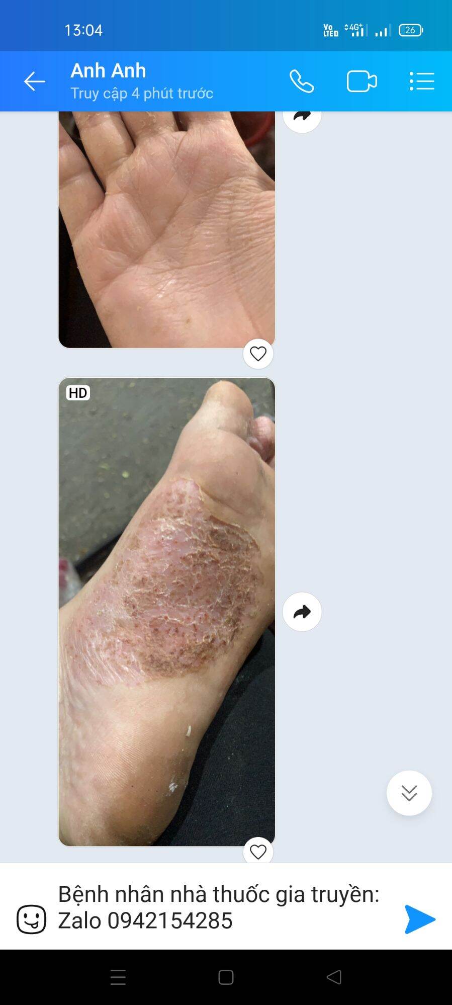 Nấm ngứa ngoài da