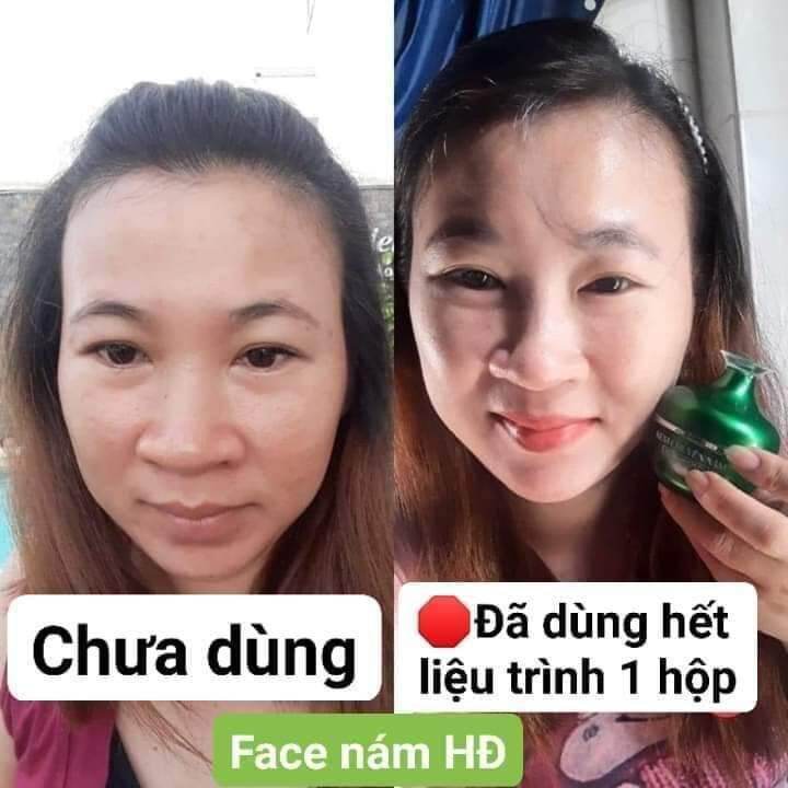 Kem chuyên nám huỳnh đỗ