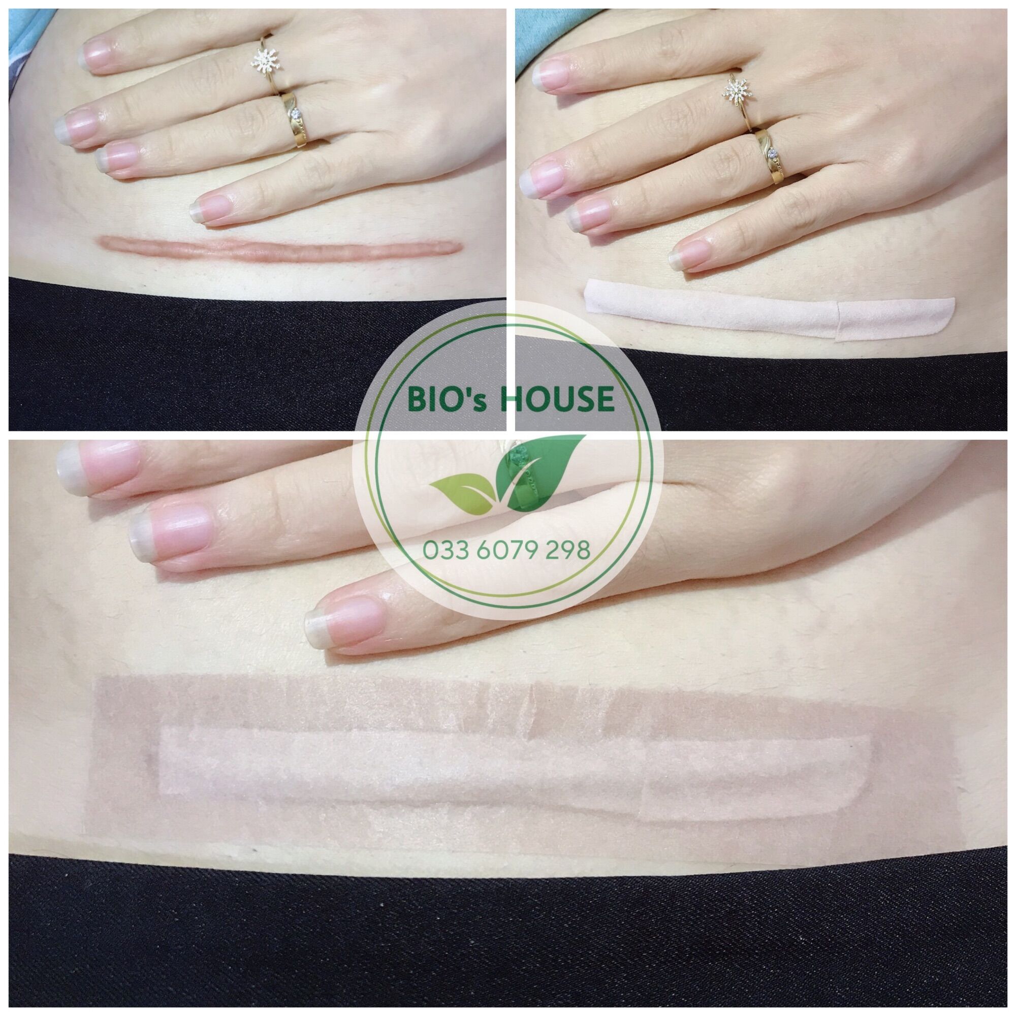 Miếng dán ép sẹo lồi ECLAR PLASTER (HISAMITSU) Nhật Bản - (Date mới)