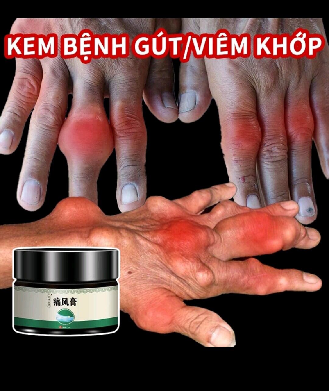 Kem bôi Gút, giảm đau , giảm xưng khớp, Gút loại bỏ axitguric