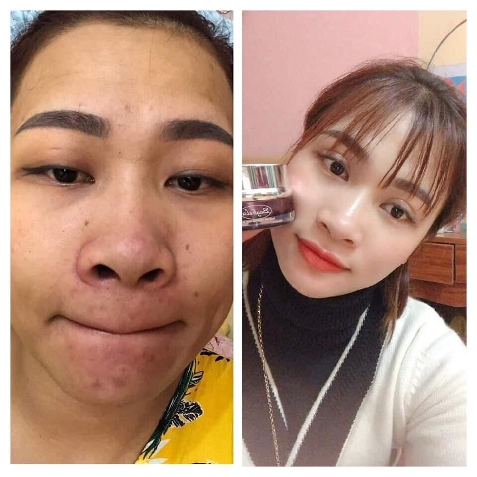 Kem mụn baybela ( hop số 5)