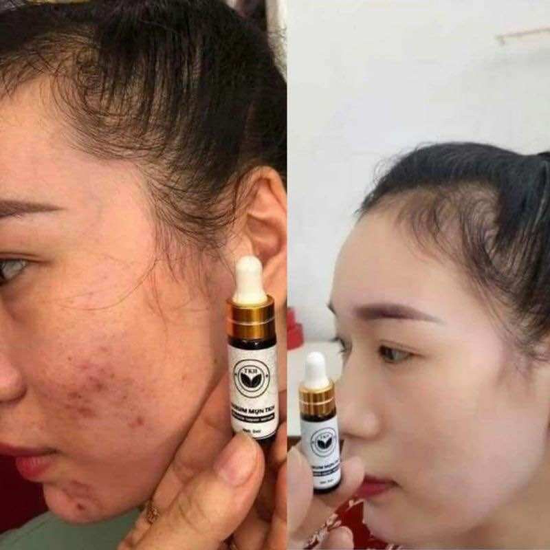SERUM MỤN TRẦN KIM HUYỀN