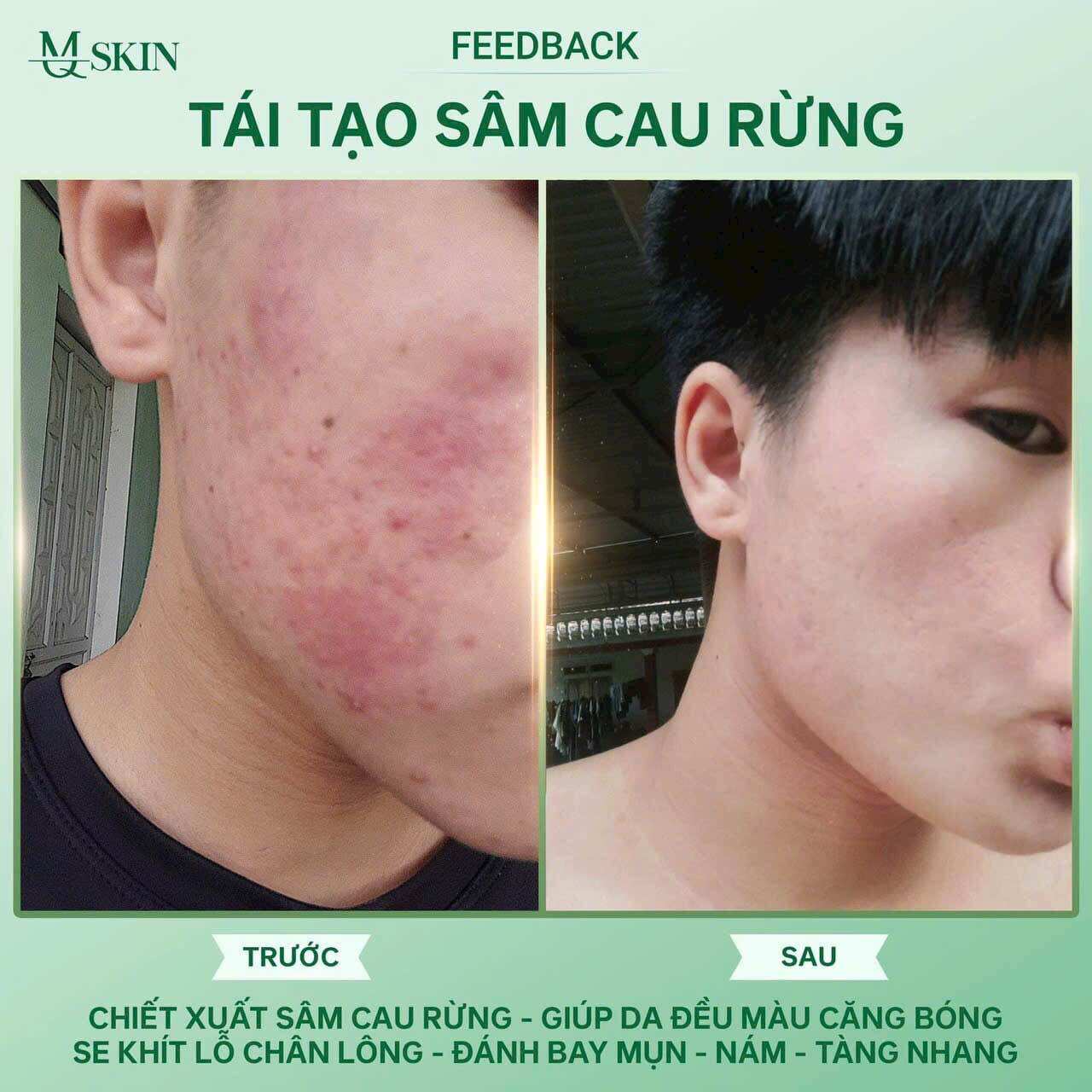 Combo Tái tạo sâm cau rừng( liệu trình 3 món)