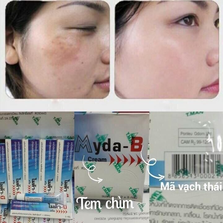 Kem Myda-B đánh bay Nám Tàn nhang thái lan