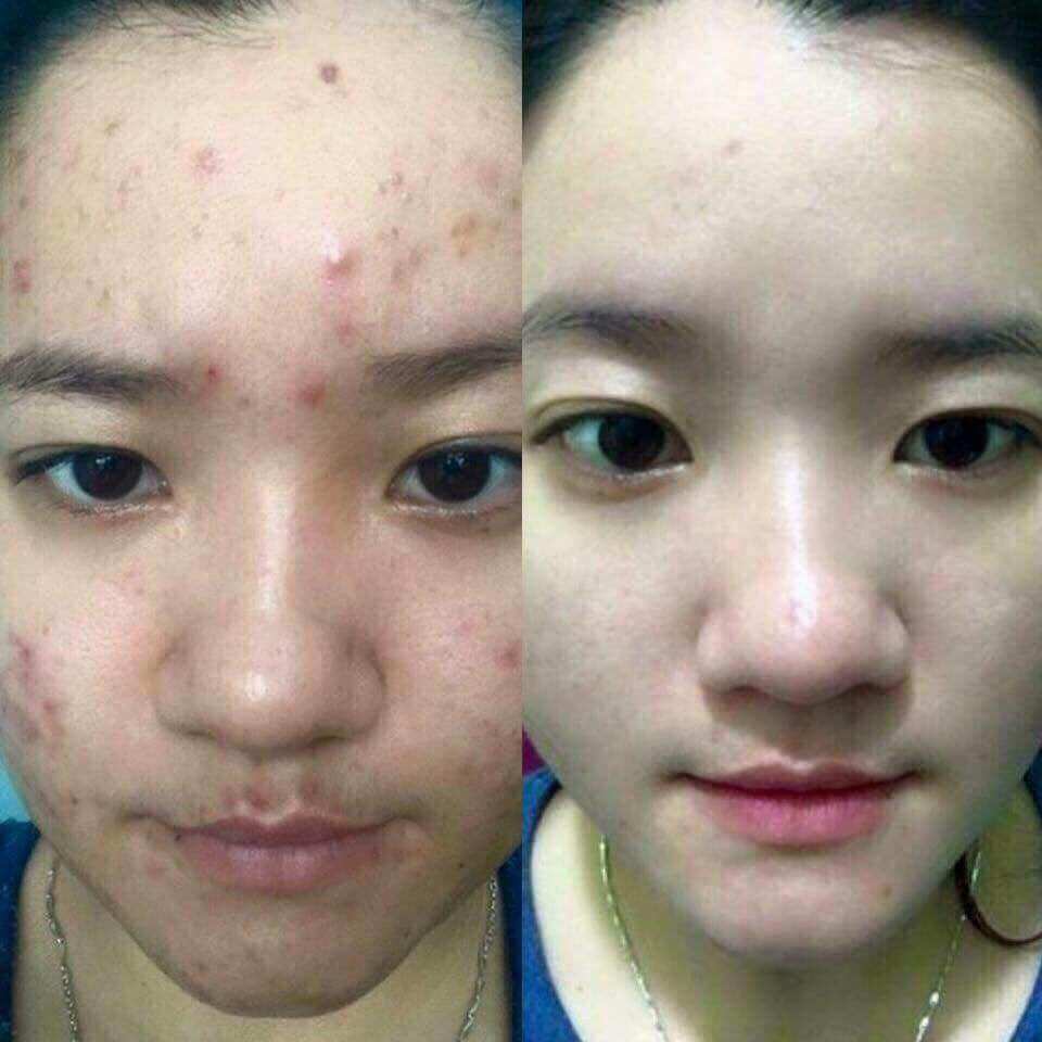 Kem Ngăn Ngừa Mụn Acne DR CELL 30gram