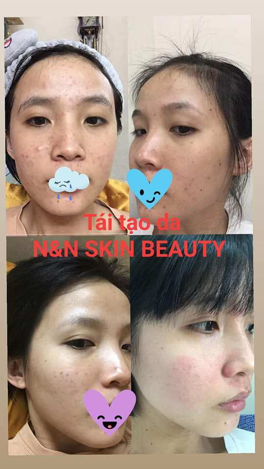 TINH CHẤT TÁI TẠO DA N&N(Chính hãng 100% giảm giá 10%)