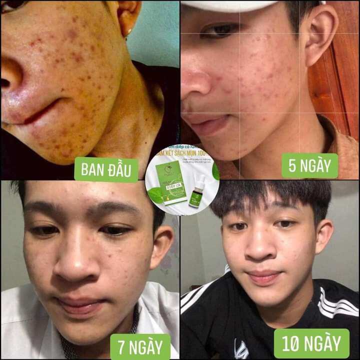 SỮA RỬA MẶT DIẾP CÁ TẤT CẢ MỌI LOẠI DA