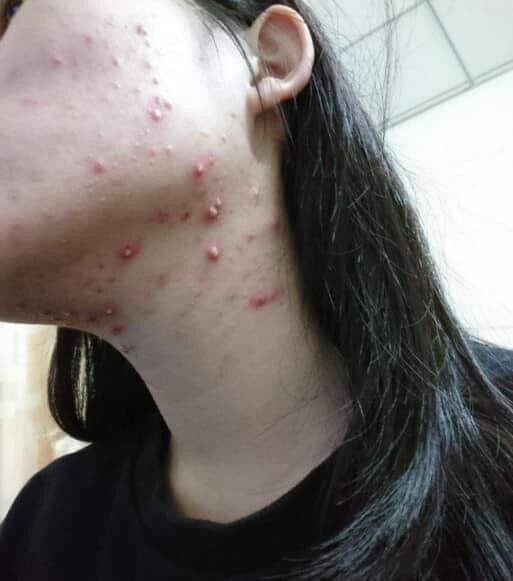 [HCM]SERUM JIUHE MỤN ACNE EXTRA THANH TÔ