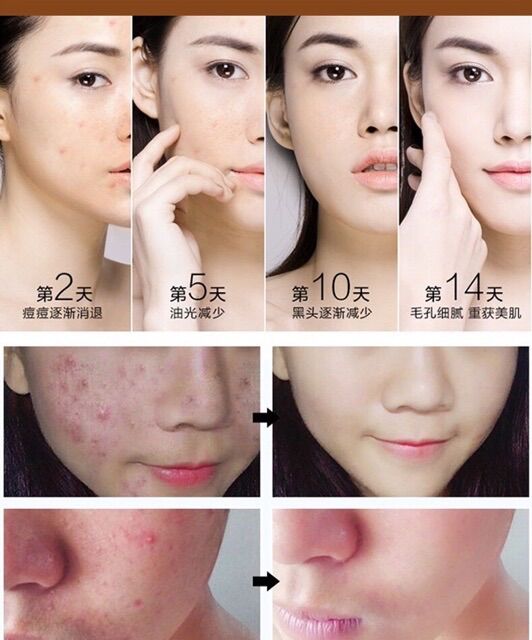 Kem Giảm Mụn Chiết Xuất Nhân Sâm