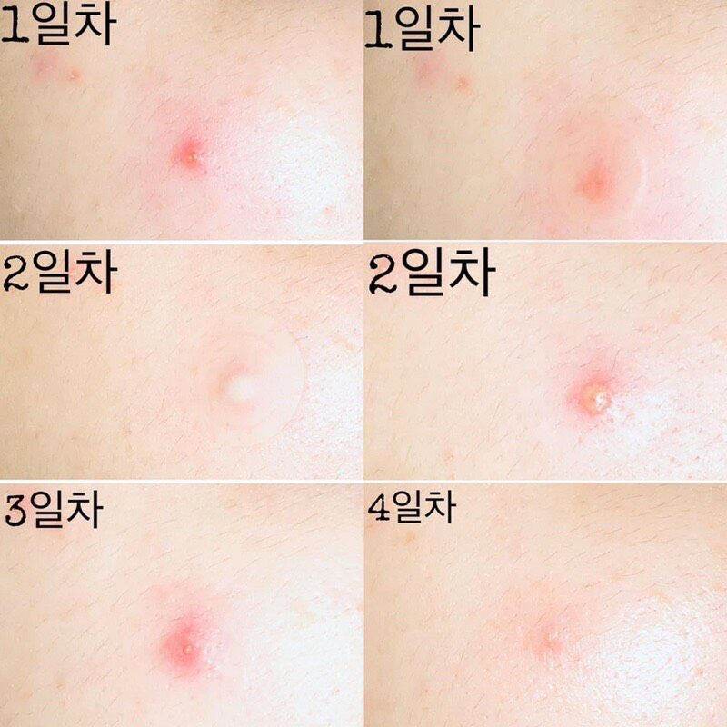 Miếng dán mụn Olive Young Care Plus Spot Patch 102 miếng + Tặng thêm 24 miếng