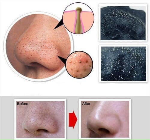 GEL LỘT MỤN KOSE NHẬT BẢN 25g