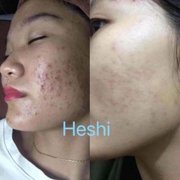 serum chấm mụn analota