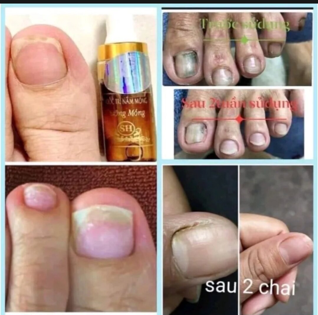 Hết nấm móng, hư khoé phục hồi móng hư tổn gia truyền