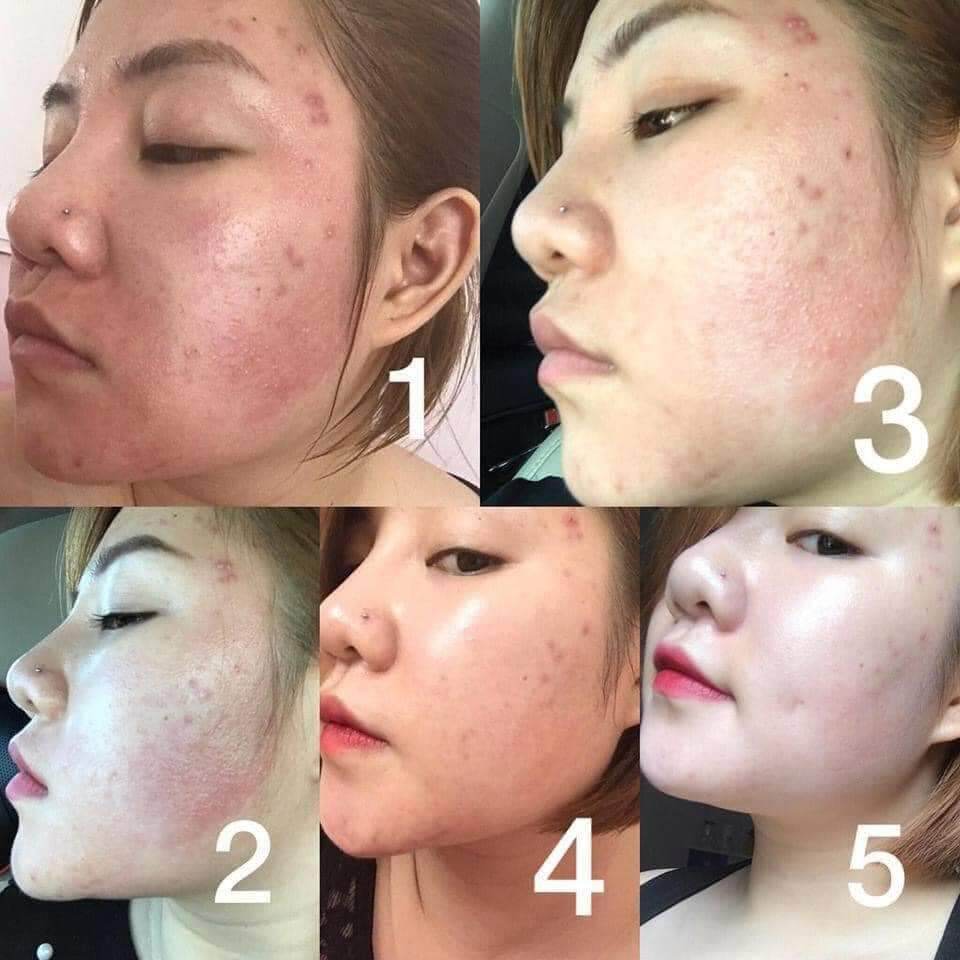 Serum ong Kosxu căng bóng thánh mụn ẩn