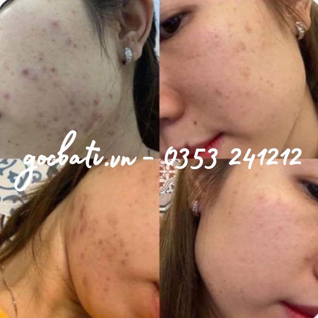 NẠ CHƯNG THẢO DƯỢC KÈM XÔNG