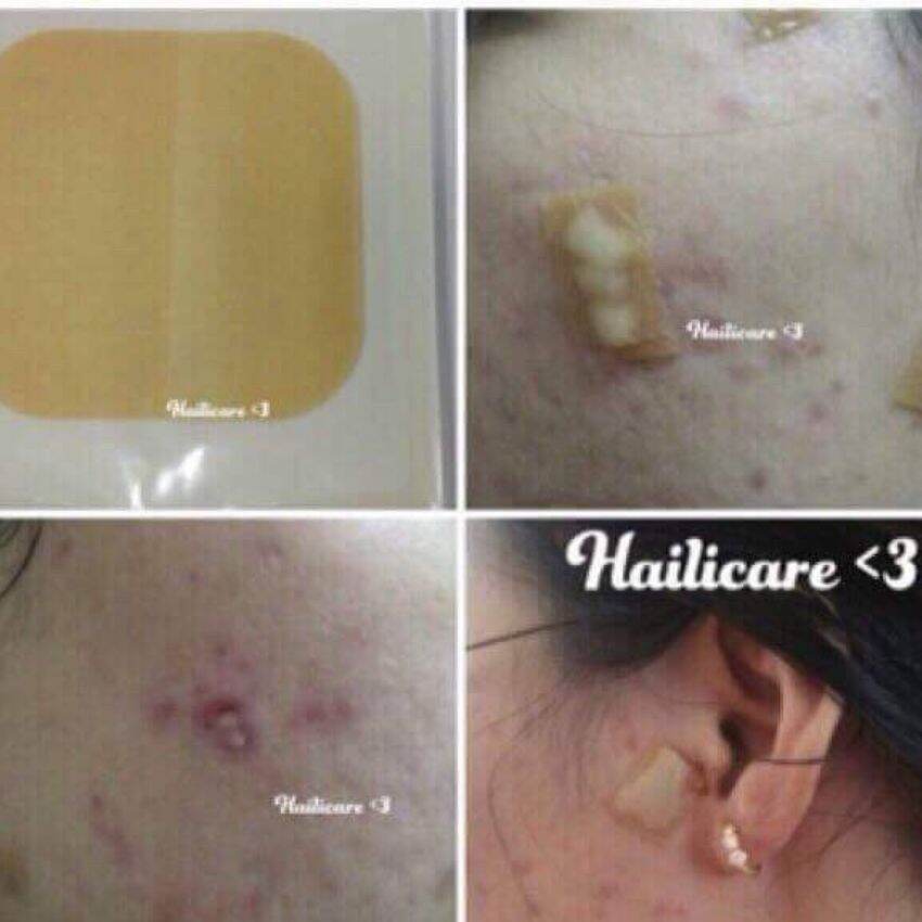 Miếng dán mụn Duoderm extra thin, chăm sóc da khỏi lo mụn mủ +5kim