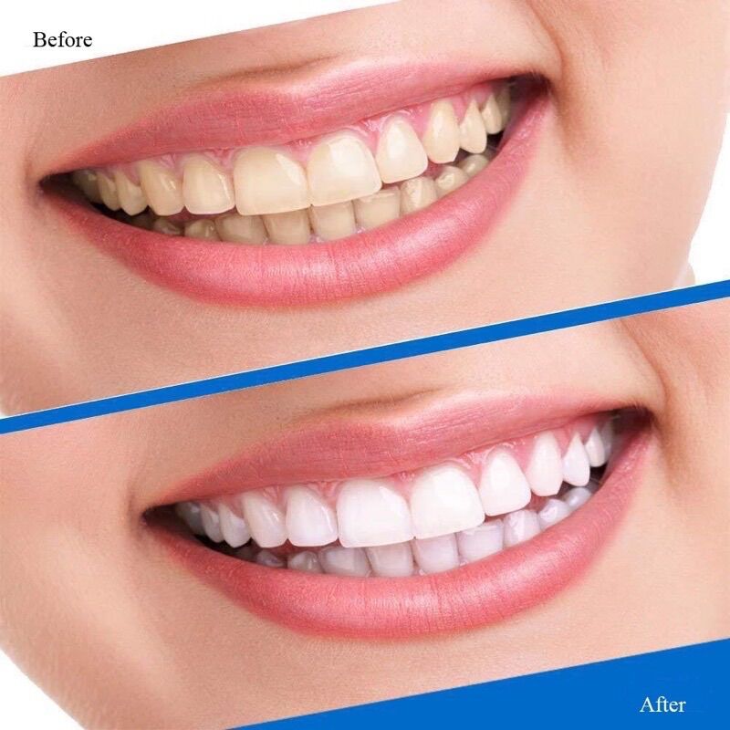Miếng dán trắng răng tiện lợi 5D White Teeth Whitening Strips
